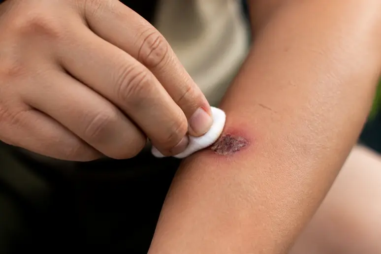 Nettoyage doux de la lésion cutanée avec une compresse antiseptique pour prévenir l'infection.